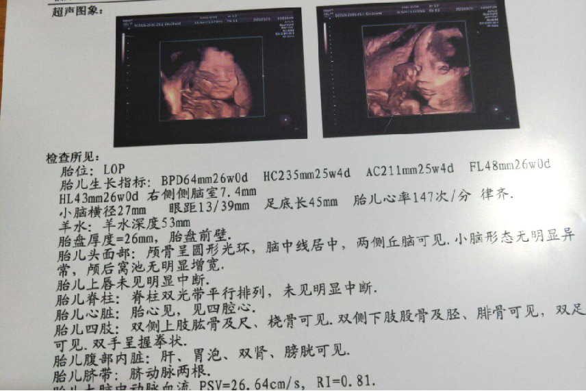 怀孕25周四维彩超图