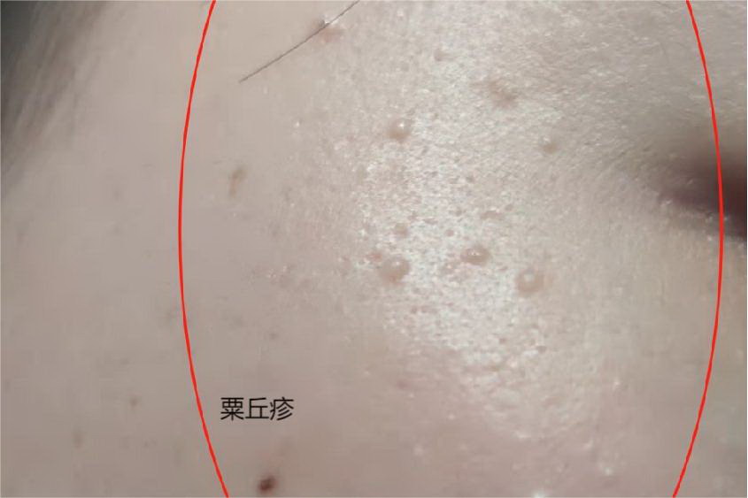 粟丘疹图