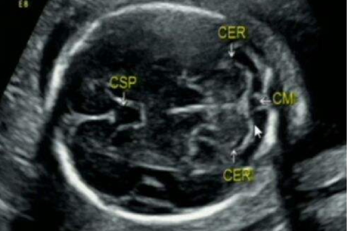 胎儿颅脑超声解剖图