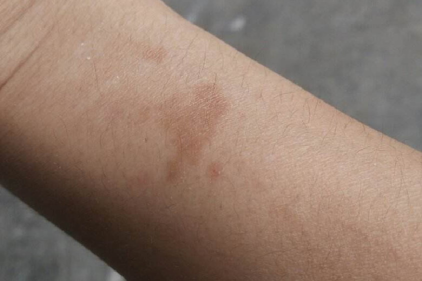 手臂有褐色斑图片