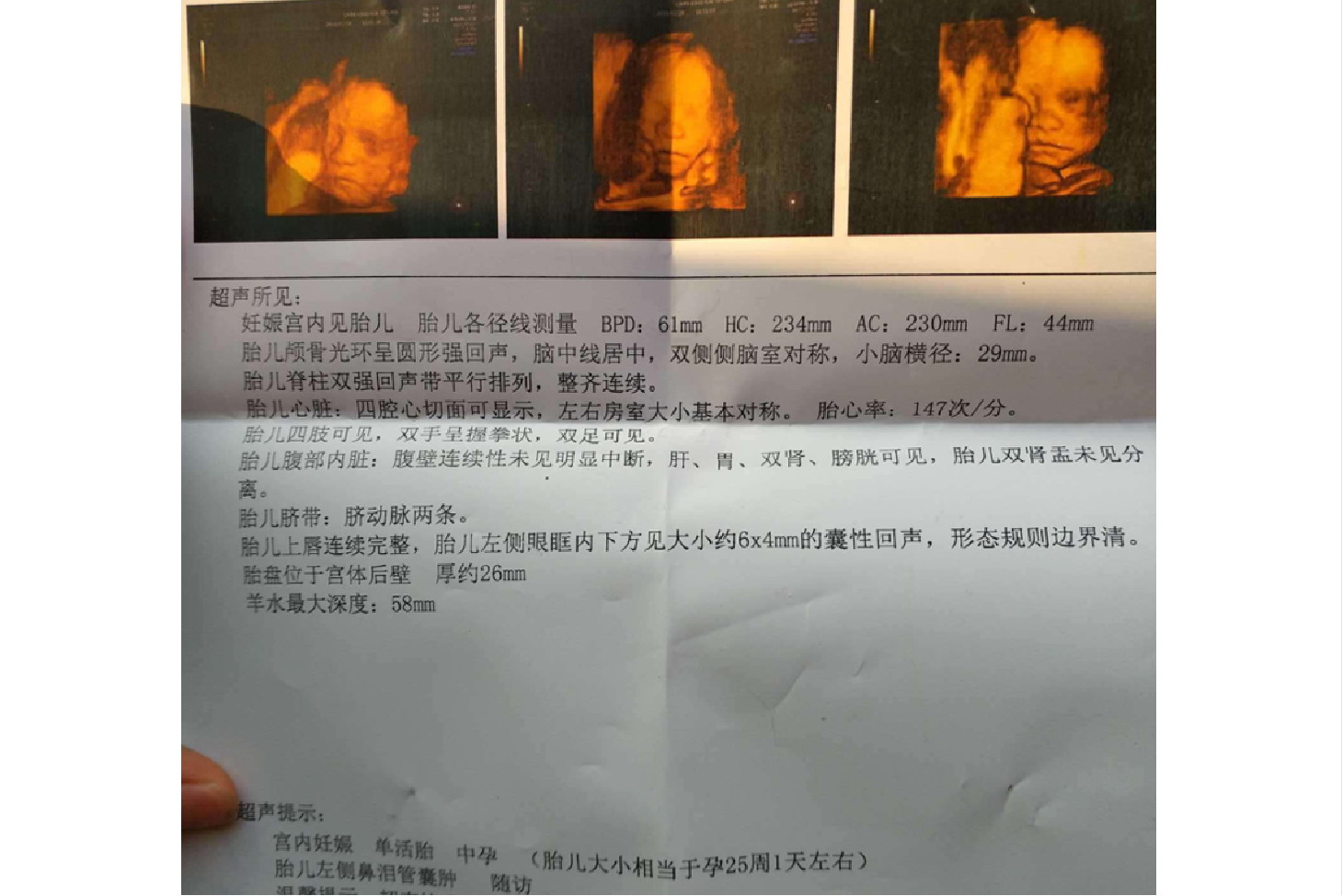 胎儿鼻泪管囊肿图片