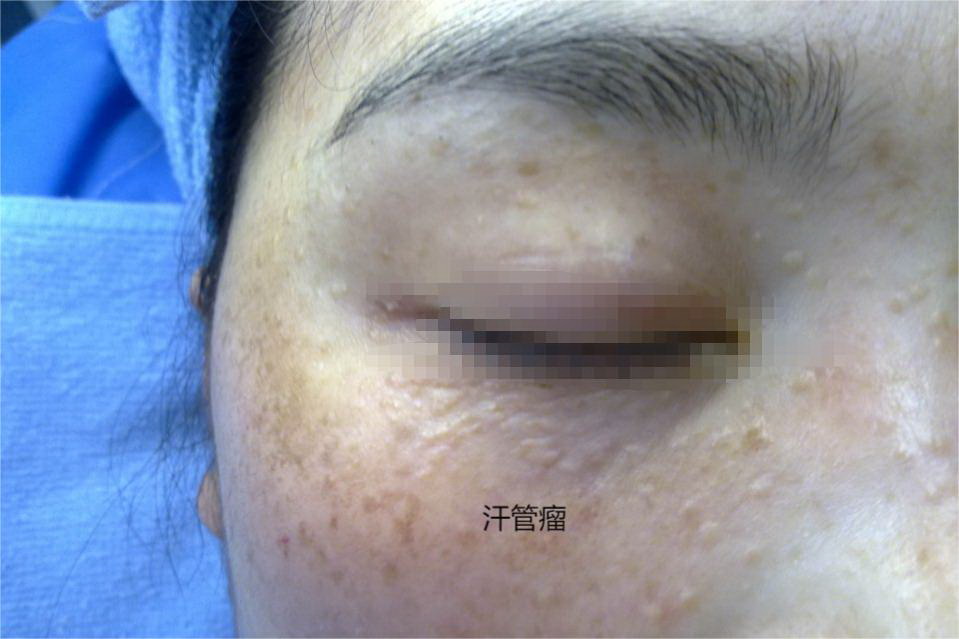 汗管瘤图
