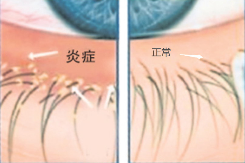 眼睛糜烂-睑缘炎图片