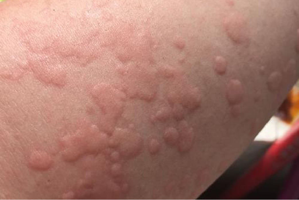 蜘蛛网过敏长红疙瘩图