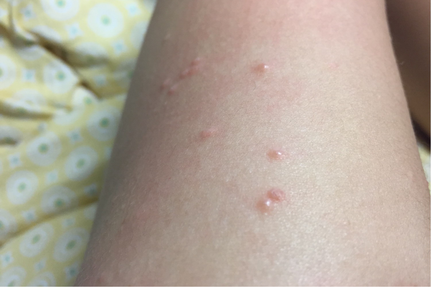 喝牛奶身上起疙瘩图片