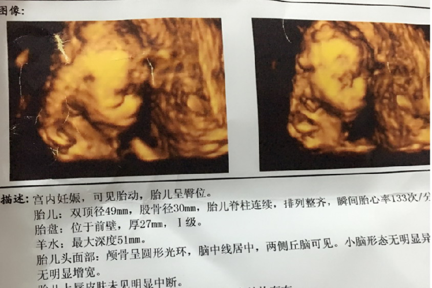 孕20周胎儿图