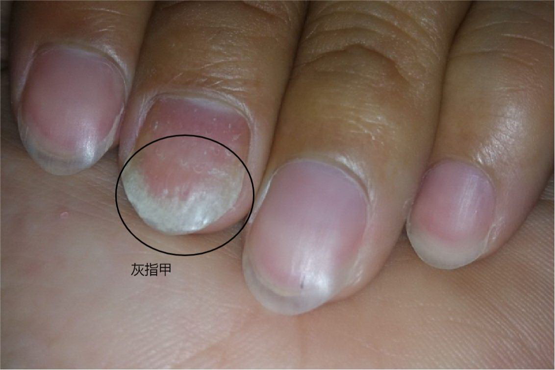 女性手指灰指甲图