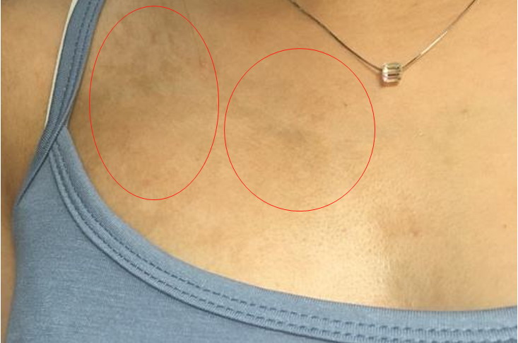 胸前黑色素沉淀图片