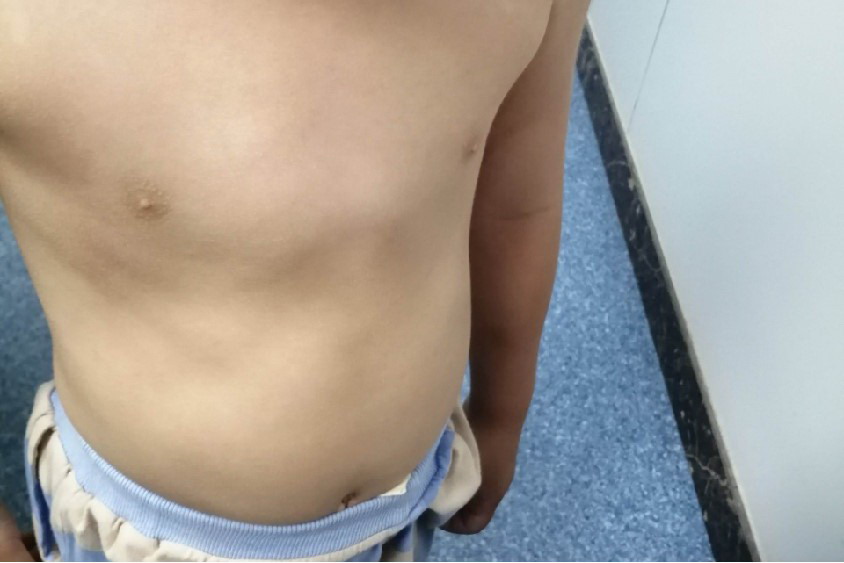 宝宝缺钙胸骨突出