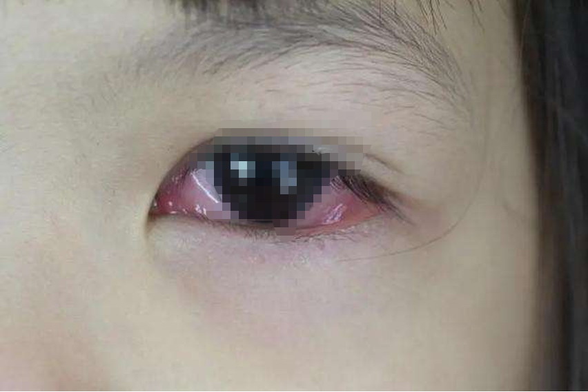 过敏性结膜炎水肿图