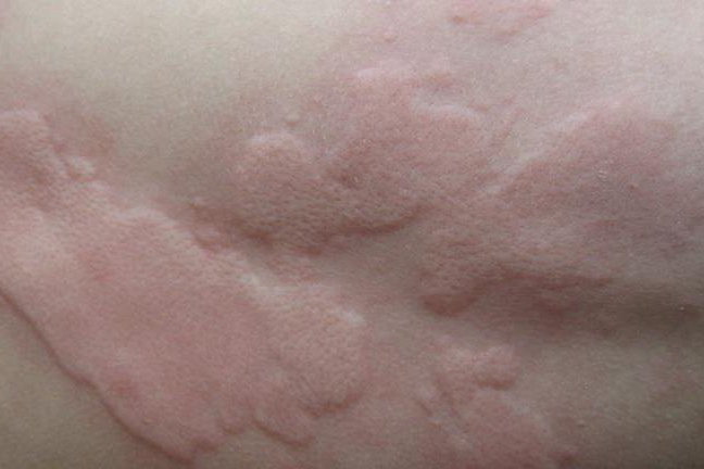 急性荨麻疹图片