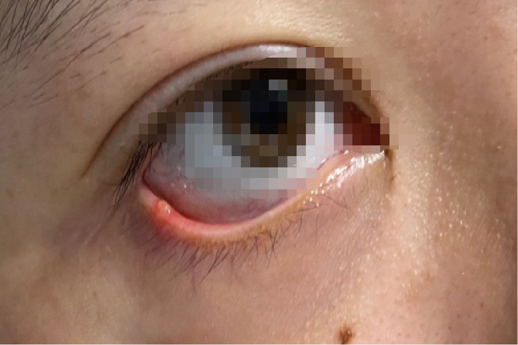 下眼睑麦粒肿初期图