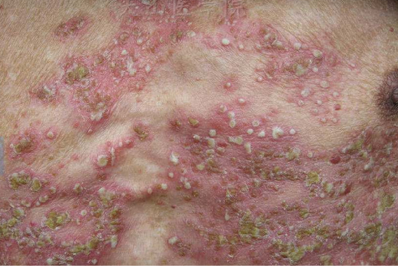 疱疹银屑病图片