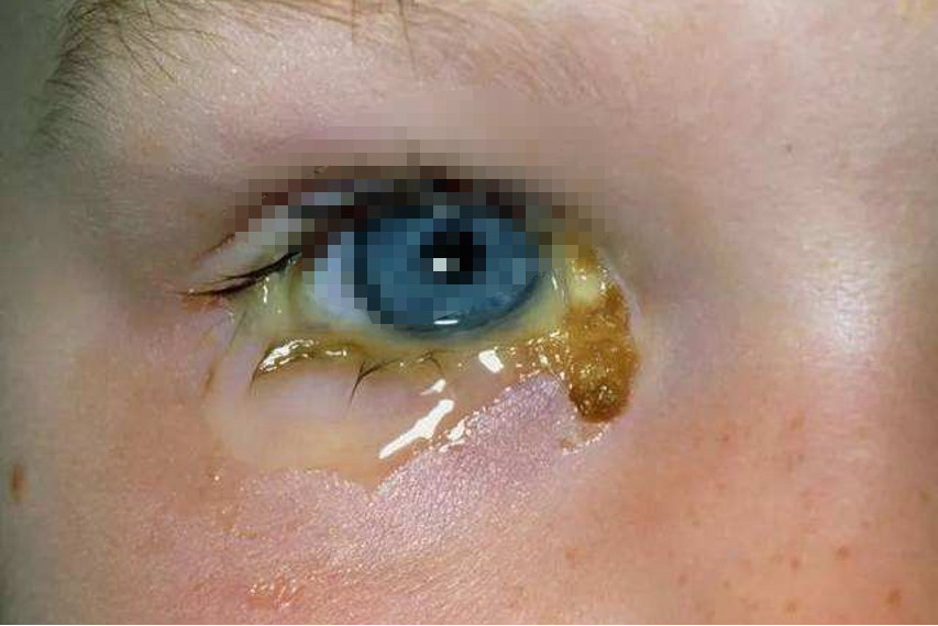 病毒性结膜炎分泌物图