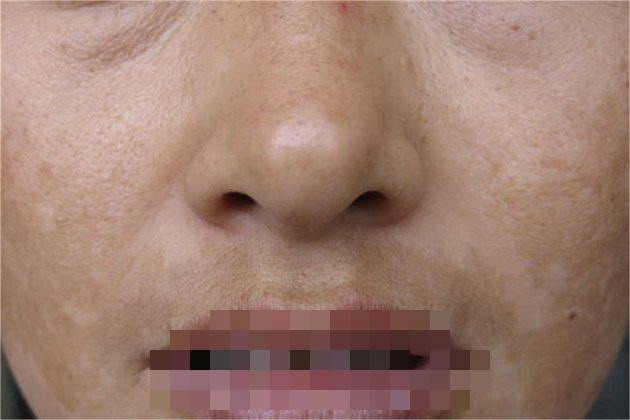 孕期黑色素沉淀图片