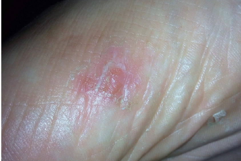 抓挠皮肤像烫伤一样图片