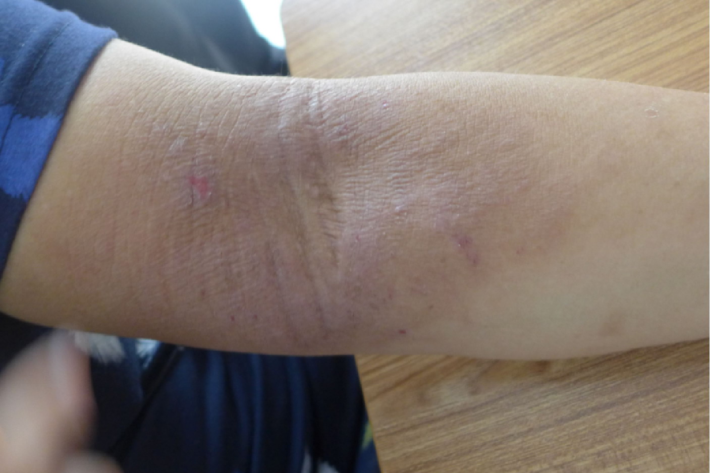 老年性特应性皮炎图片