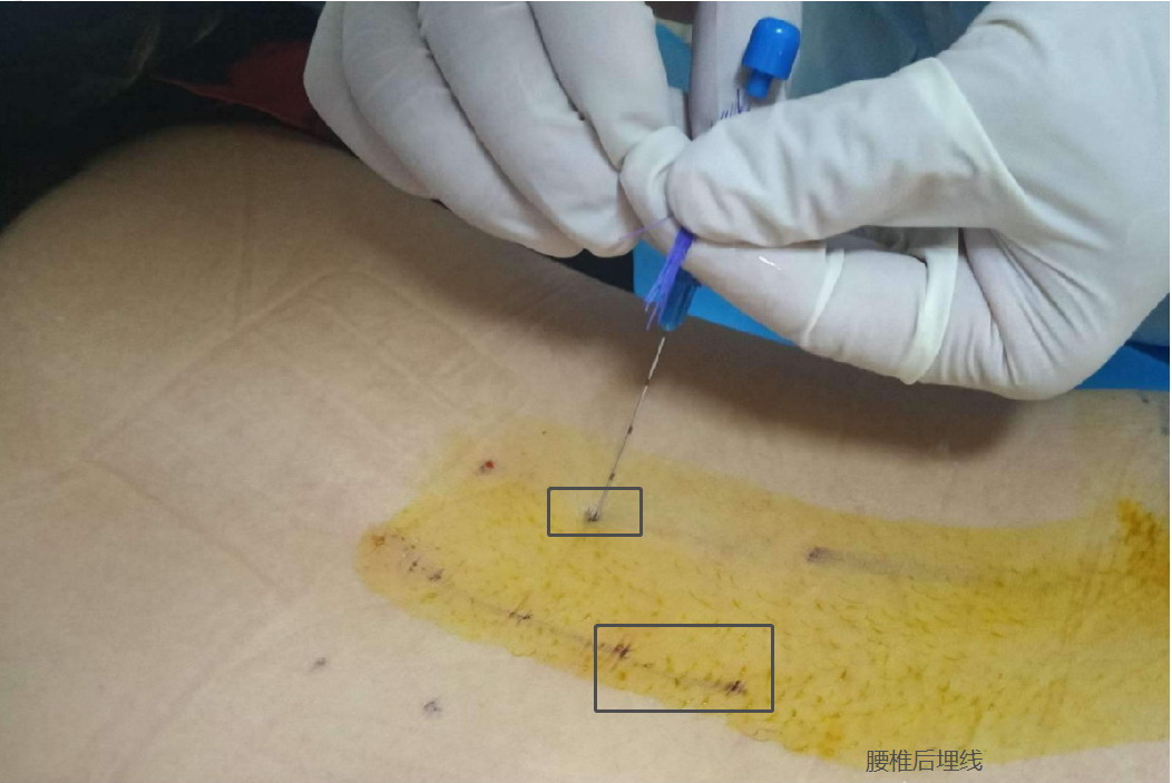 腰椎间盘突出后埋线图