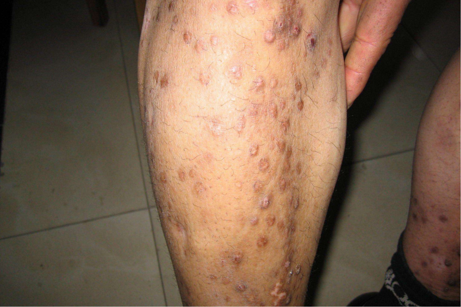 麻风结节性红斑图片