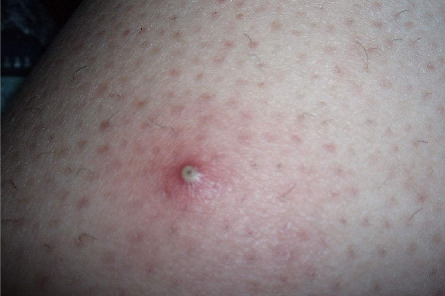 女性大腿内侧毛囊炎图片