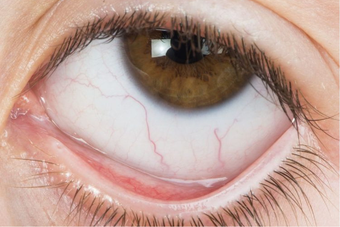 1,贫血:眼睑苍白通常是贫血的一种体征,贫血的患者除了出现眼睑苍白