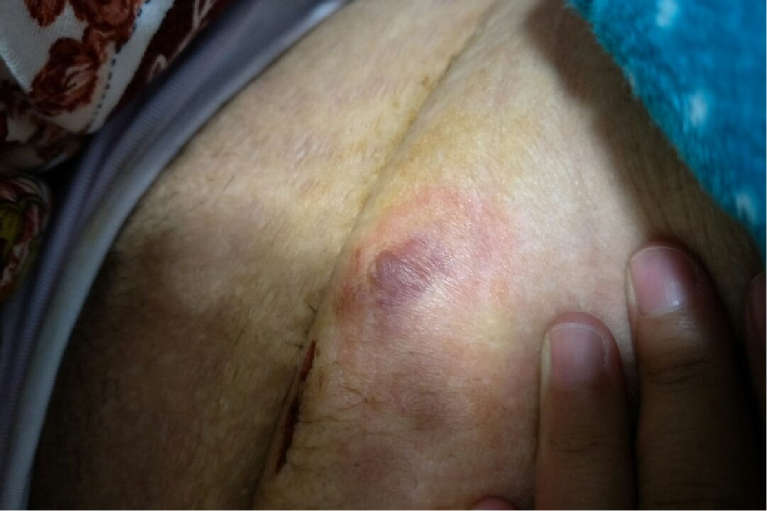 剖宫产伤口长水泡图