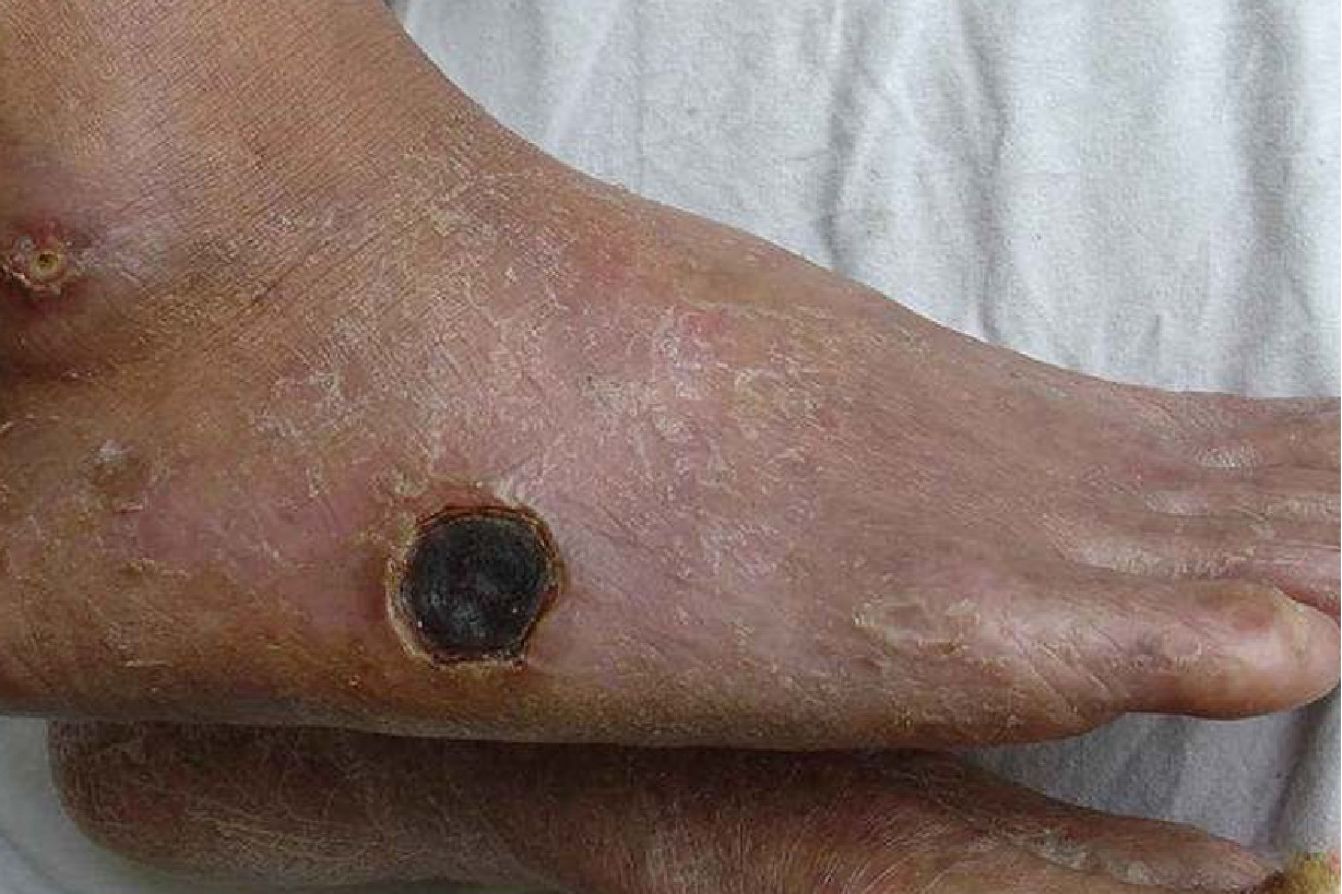 皮肤粥样硬化图