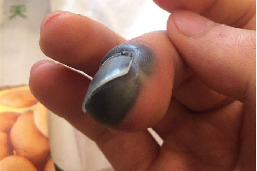 手指被夹发青图片