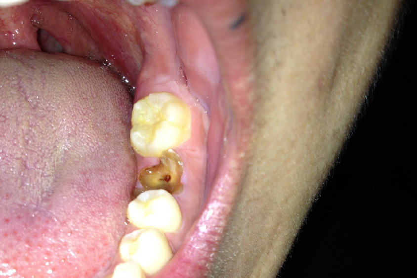 倒数第二颗牙齿烂了图