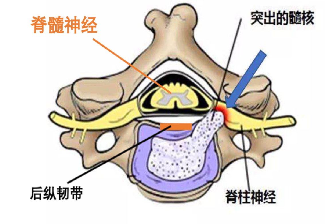 神经根型颈椎病图