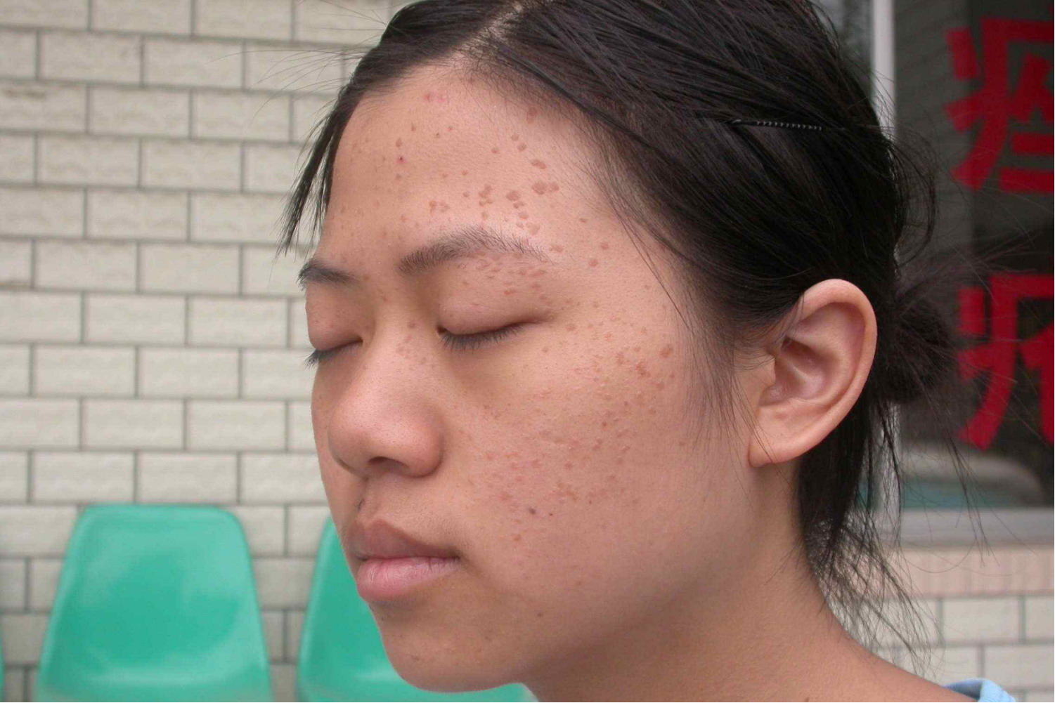 黑色扁平丘疹图片