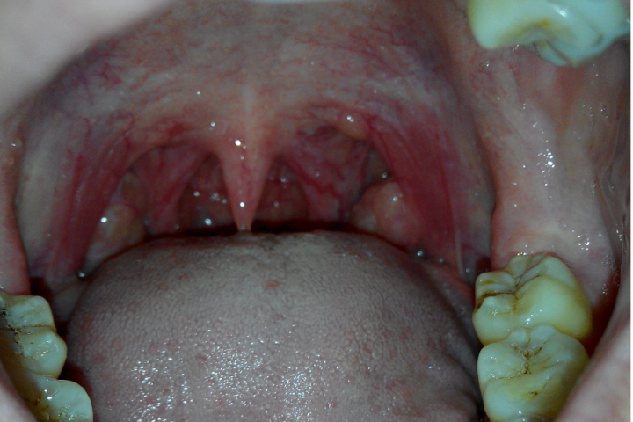 正常咽扁桃体图片图片