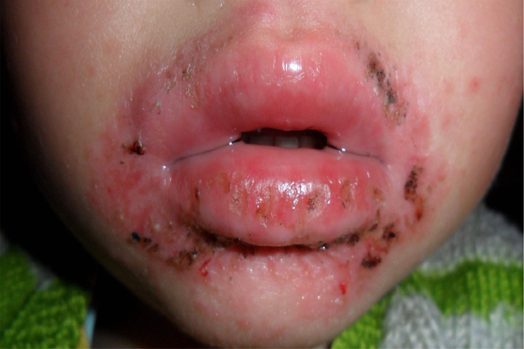 嘴巴湿疹的症状图片图片
