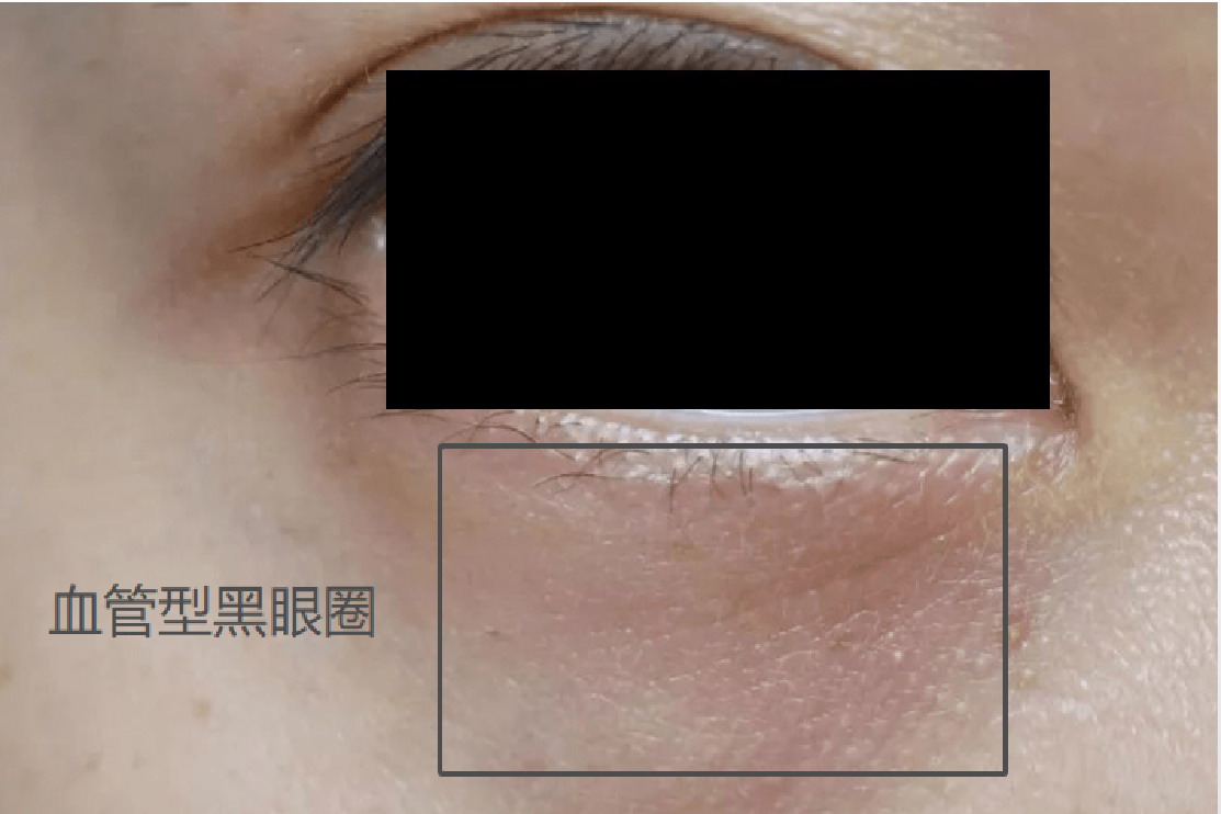 血管型黑眼圈图片