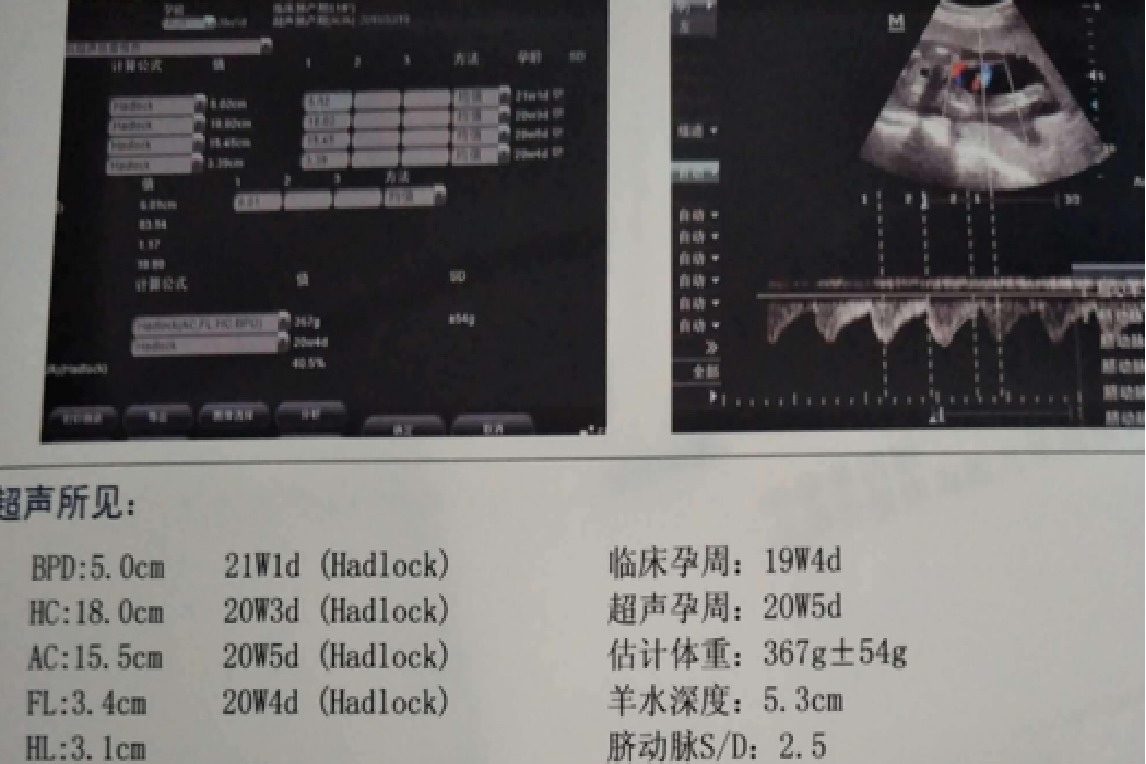怀孕19周胎儿彩超图