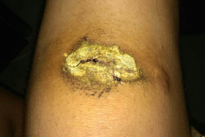 皮肤擦伤结黄痂图