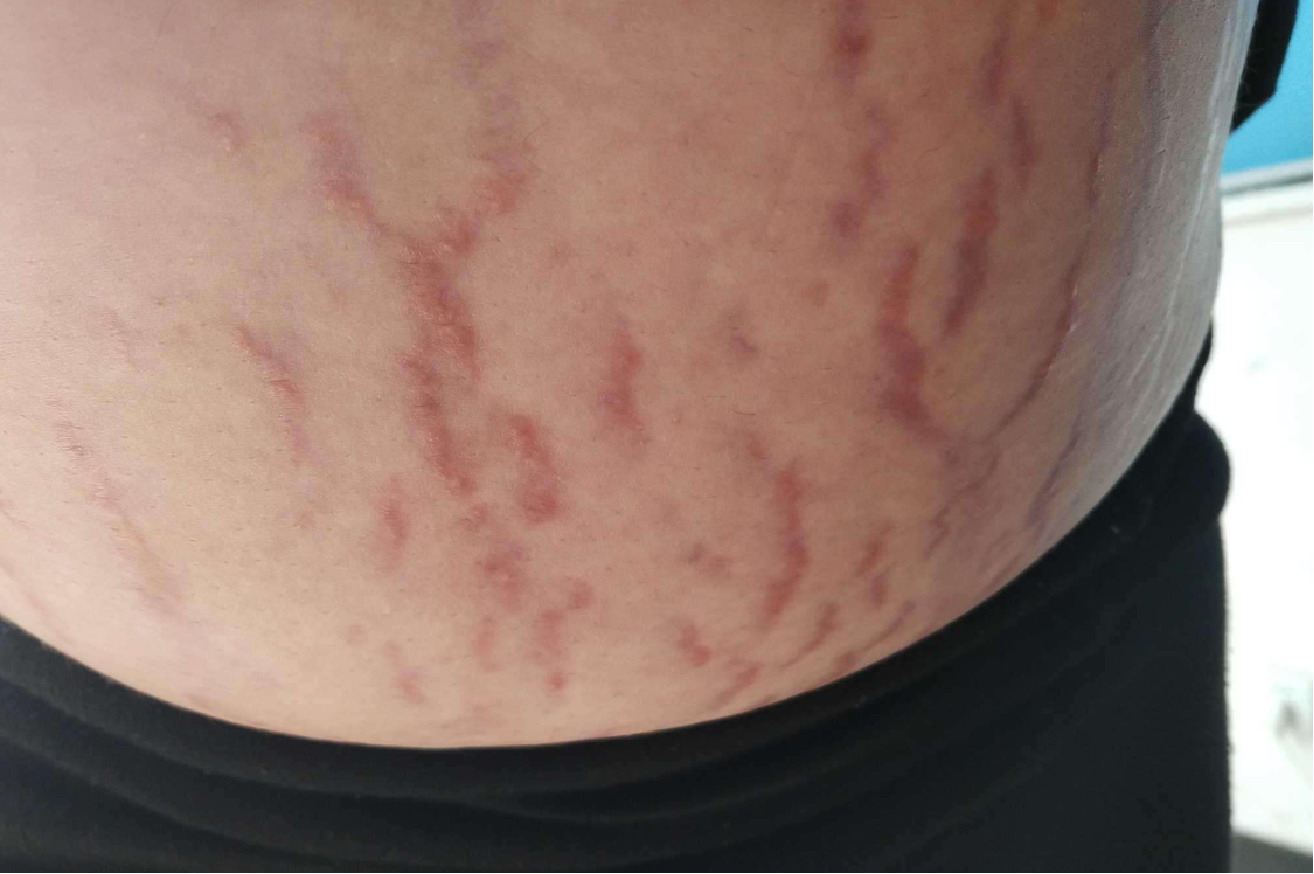 腹部妊娠纹图片