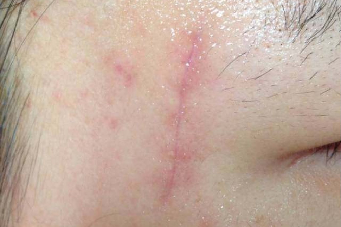 浅表性疤痕图片