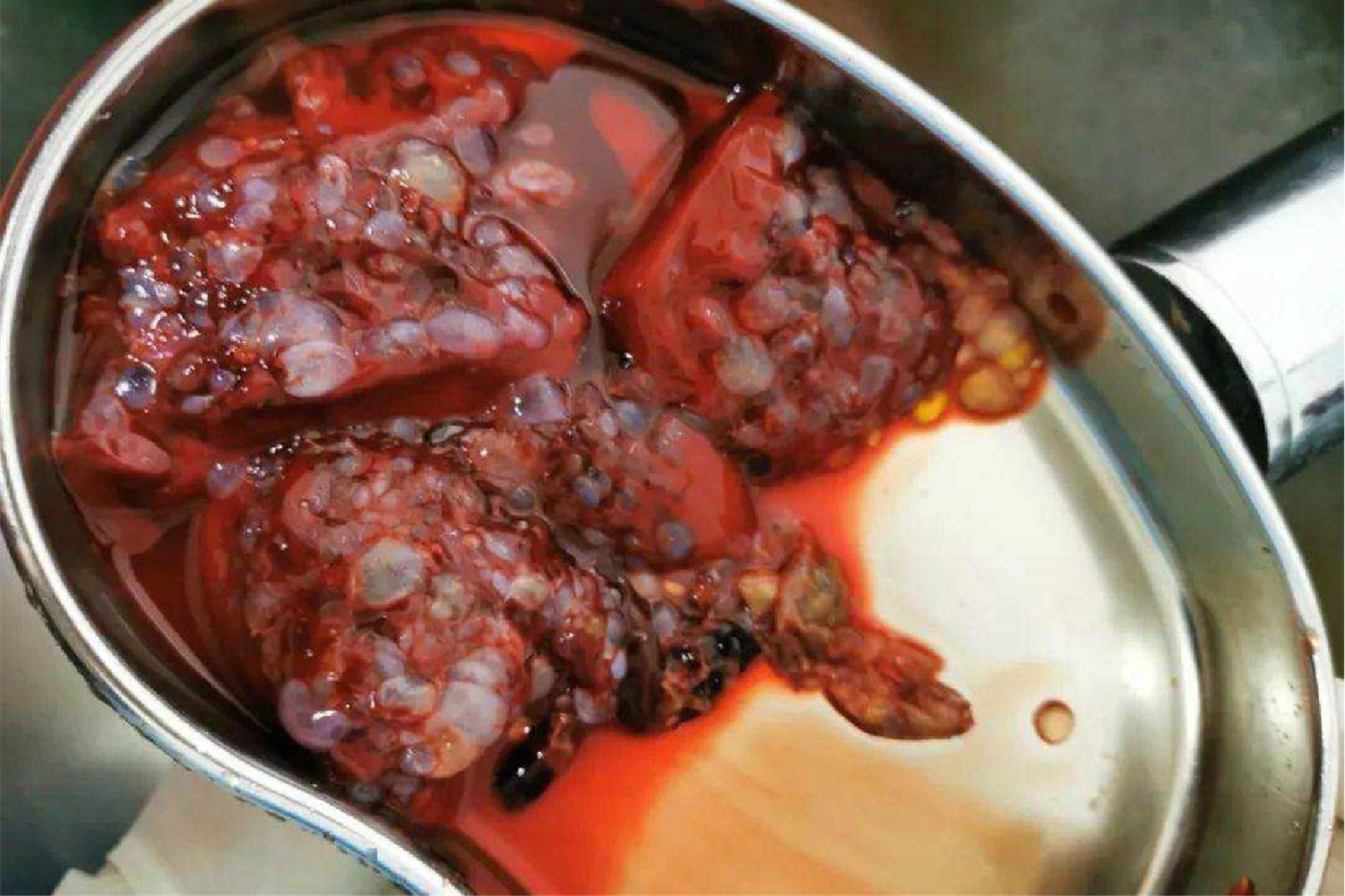 流产的葡萄胎图