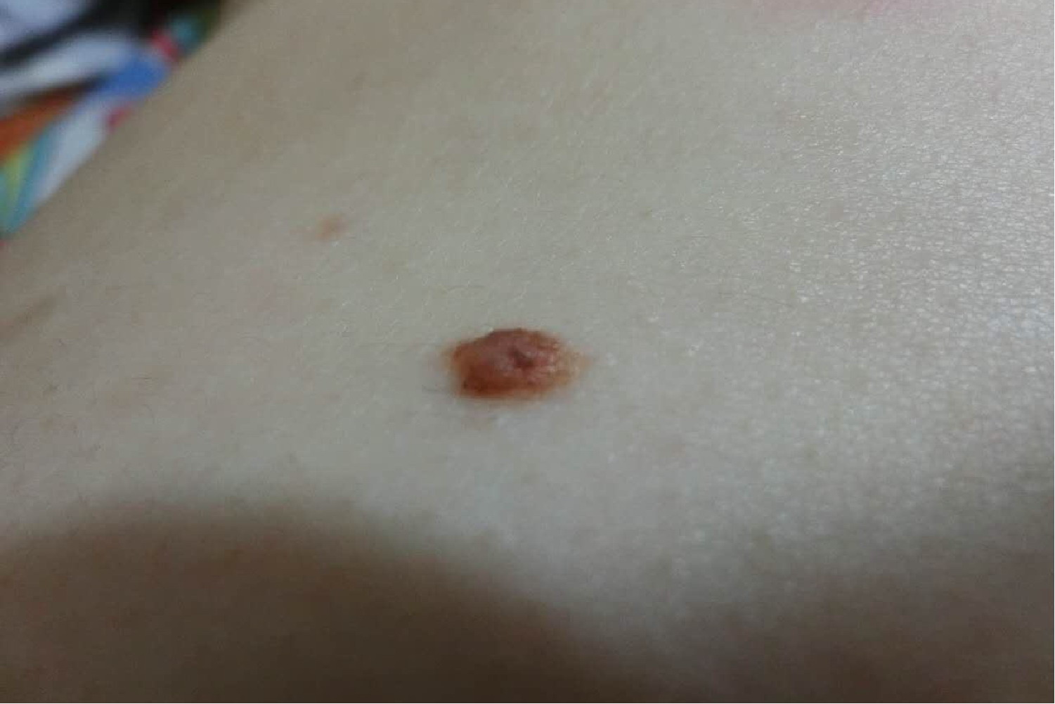 腿上长了个肉痣图