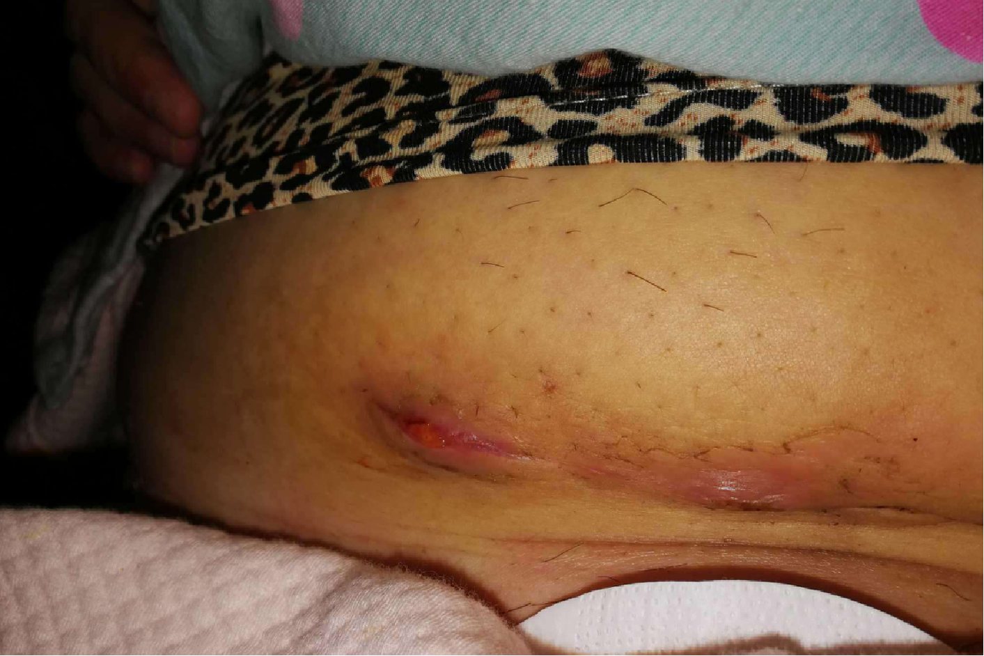 剖腹产刀口脂肪液化图