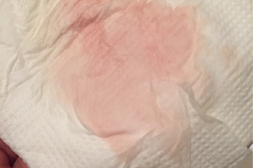 怀孕阴道有淡粉色分泌物图