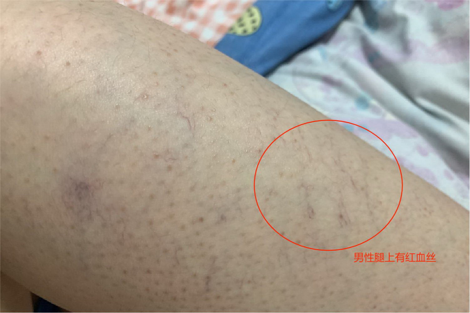 男性腿上有红血丝图