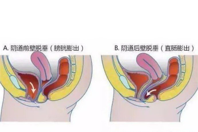 阴道壁膨出图片