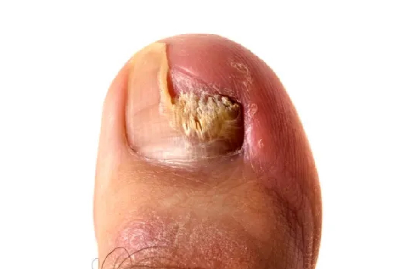 甲癣远端侧位甲下型图