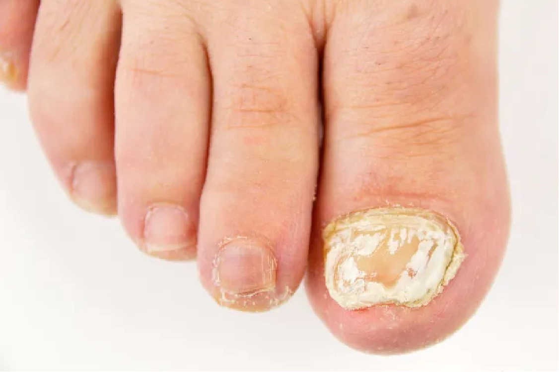 甲癣白色浅表型图