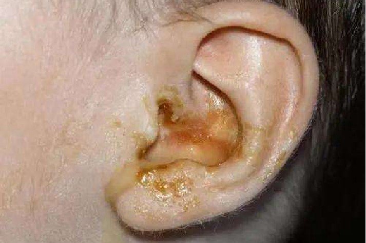 浆液性耳漏图片