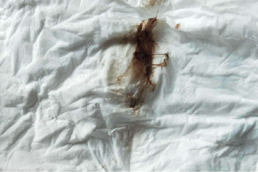 剖宫产后阴道黑色血图