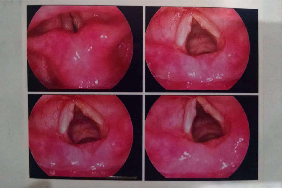咽喉后壁白斑图片高清图片