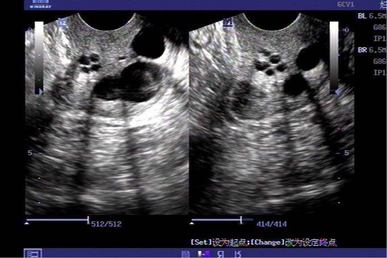 子宫颈多发囊肿图片